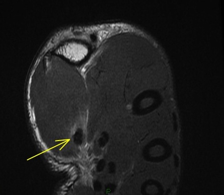 Figure 3 for case Flexor pollicis longus tendon ( RID2383 ) laceration